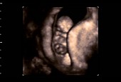 Foetus, 4D ultrasound scan