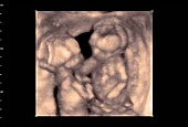 Twin foetuses, 4D ultrasound scan