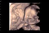 Foetus, 4D ultrasound scan