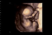 Foetus, 4D ultrasound scan