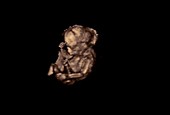 Foetus, 3D ultrasound scan