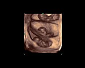 Triplet foetuses, 4D ultrasound