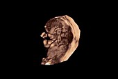 Foetus, 3D ultrasound scan