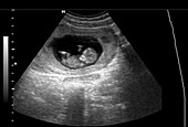 2D foetal ultrasound