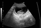 Ultrasound scan of a foetus