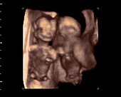 Twins foetuses, 4D ultrasound scan