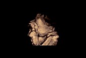 Foetus, 3D ultrasound scan