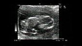 Twins, ultrasound scan