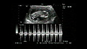 Twins, ultrasound scan