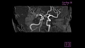 Circle of Willis, MRA scan