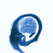 Brain tumour, MRA scan