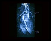 Aortic arch, MRA scan