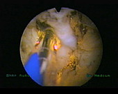 Laser prostate surgery