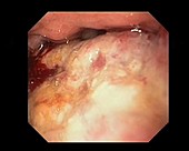 Stomach cancer biopsy, endoscope view