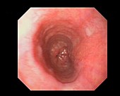 Healthy oesophagus, endoscope view