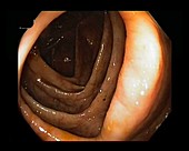 Healthy human colon, endoscope view