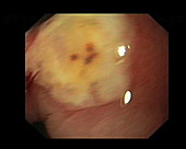 Stomach ulcer, endoscope view