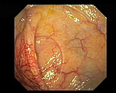 Vascular abnormality