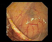 Vascular abnormality