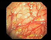 Vascular abnormality