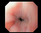Oesophageal inlet patch