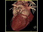 Rotating scan of a heart