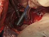 Mitral valve replacement