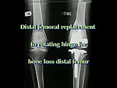 Distal femoral replacement