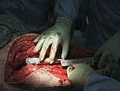 Total femoral replacement