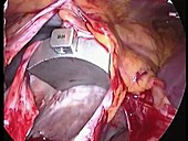 Keyhole mitral valve surgery