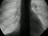 Lungs breathing, X-ray