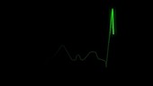 ECG heart trace