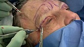 Facelift operation