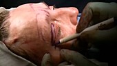 Facelift operation