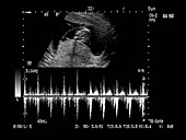 Foetal ultrasound scan and heartbeat