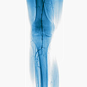 Narrowed leg arteries, angiography