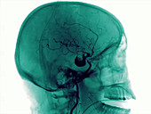 Aneurysm in the brain, angiography