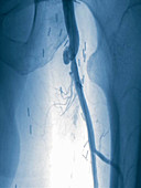 Angioplasty procedure, angiography