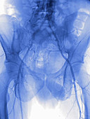 Narrowed pelvic artery, angiography