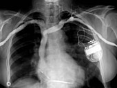 Pacemaker and defibrillator