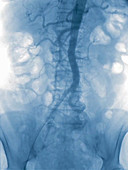 Normal abdominal arteries