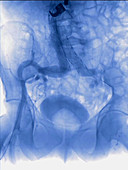 Pelvic artery, angiography