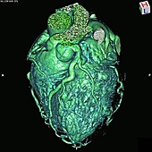 Enlarged coronary arteries, 3D CT scan
