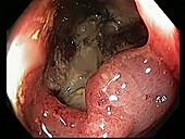 Rectal cancer, endoscope view