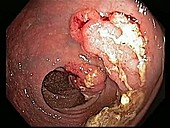 Rectal cancers, endoscope view