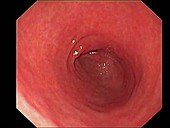 Peristalsis in the stomach, endoscopy