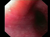 Oesophagus, endoscope view