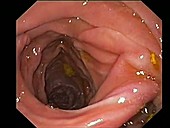 Enteroanastomosis, endoscope view