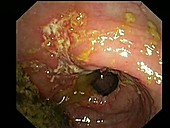 Crohn's disease, endoscope view
