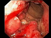 Stomach cancer, endoscope view